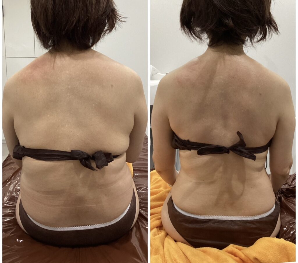 痩身の施術事例 BEFORE / AFTER