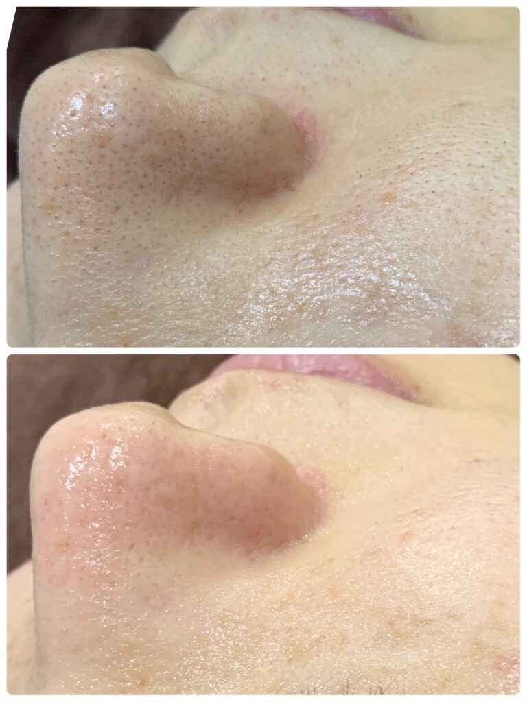毛穴ケアの施術事例 BEFORE / AFTER