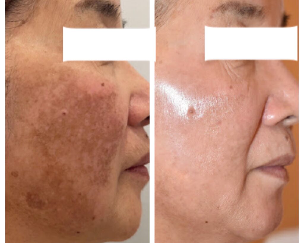 シミケアの施術事例 BEFORE / AFTER