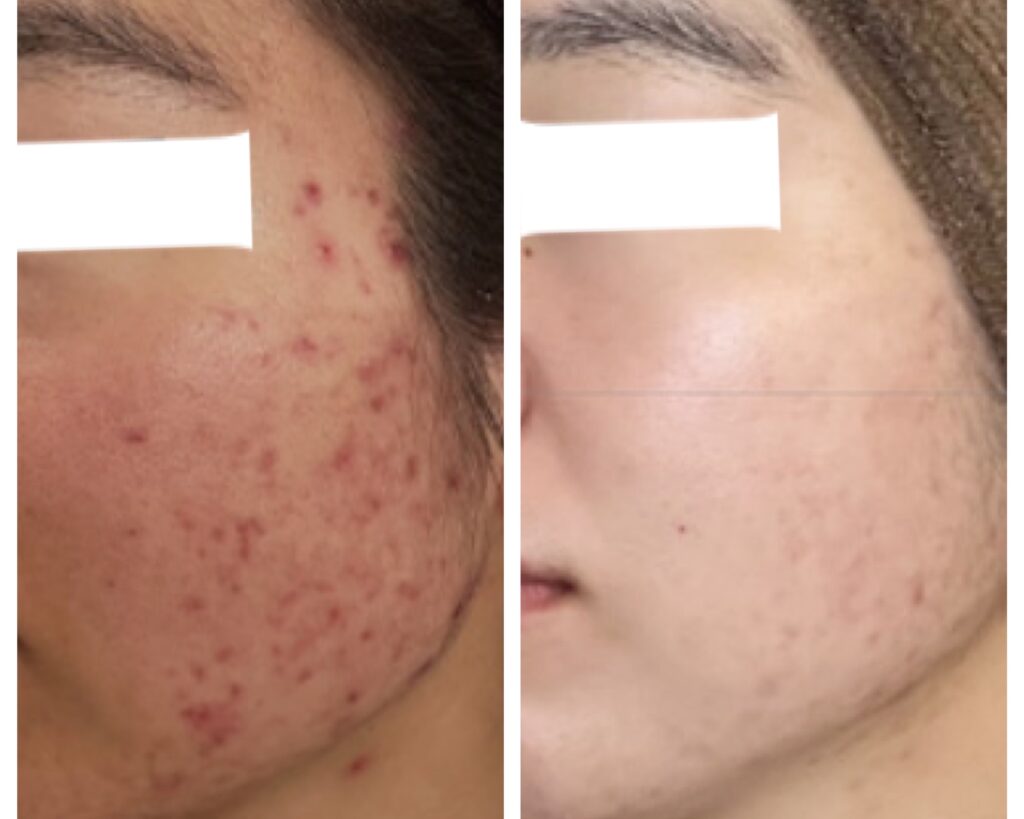 フェイシャルの施術事例 BEFORE / AFTER