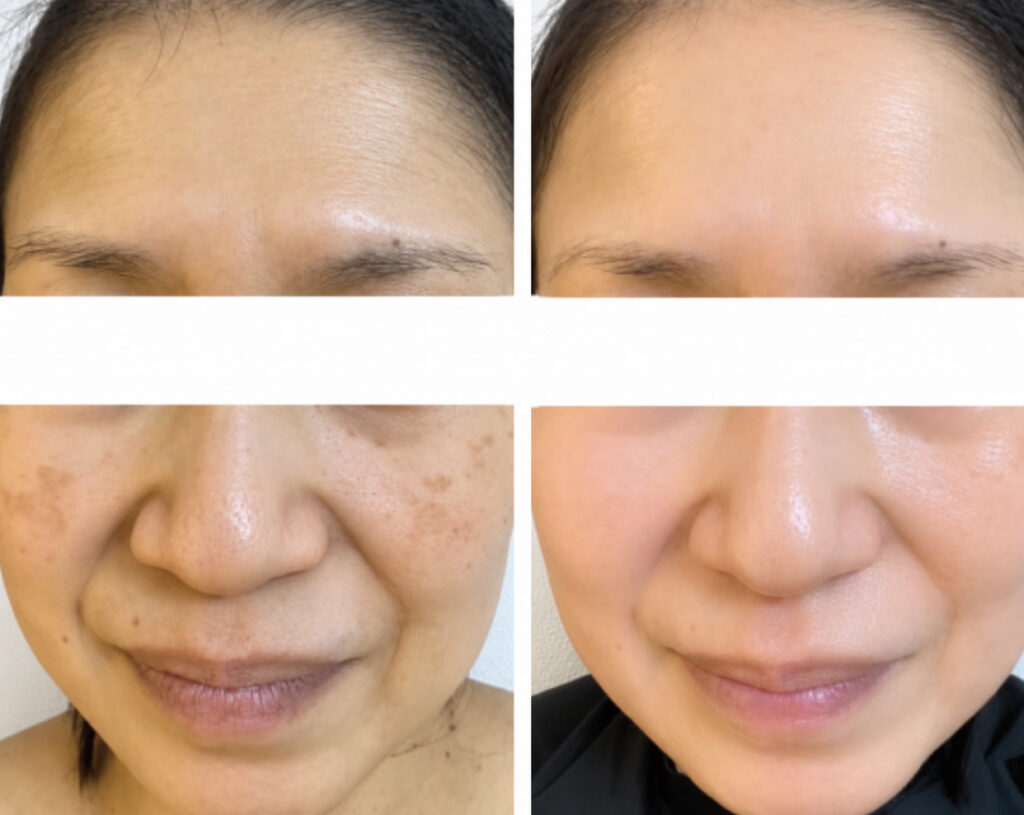 シミケアの施術事例 BEFORE / AFTER