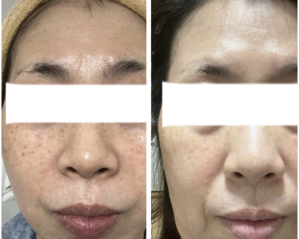 シミケアの施術事例 BEFORE / AFTER